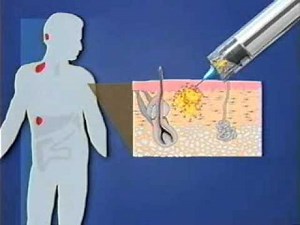 How Does a Dendritic Cell Vaccine Work?