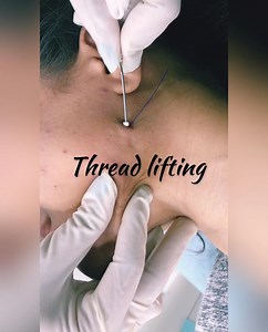 PDO THREADS - what they are actually for? PDO threads gained marketability in recent times for its versatility and results as a minimal invasive treatment If someone is looking to address their saggy skin with out surgery and longer downtime this could be the best option. The results are NATURAL AND INSTANT concerns such as smile lines,smokers lines, jowls, Turkey neck, hooded eyelids, volume loss, diminished jawline, marionette lines Etc can be addressed with PDO threads or with combination of 
