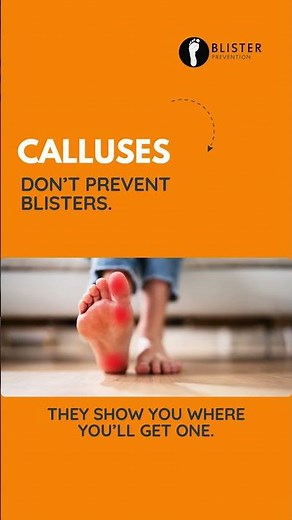 Calluses don’t prevent blisters [Blister Prevention]