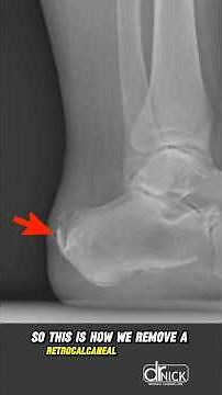 Minimally Invasive Achilles Surgery!