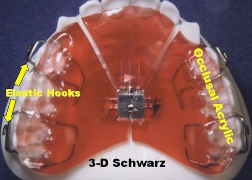 Schwarz Palatal Expander Appliance for Kids
