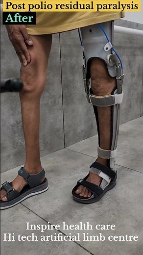 Polio Patient Walks Again 👣 | Life-Changing KAFO Brace | Inspire Healthcare Rajkot