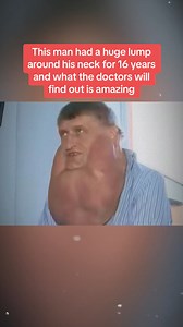 This man had a huge lump around his neck for 16 years and what the doctors will find out is amazing #truestory #story #storytime #usa Telling Stories #US #usa #fy #story | telling stories