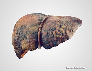 HMB Supplement Trial Explores New Treatment for Chronic Liver Disease – Archyde