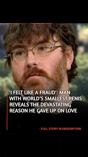NewsTigo on Instagram: "Man with 'world's smallest penis' gives heartbreaking admission on why he remained single The man behind the viral "world's smallest" headline has broken his silence with a candid and painful interview about the psychological toll of a rare medical condition. On January 10, 2026, Ant Smith—who has become a public advocate for men struggling with body dysmorphia and micropenis (a condition where the organ is significantly smaller than the average range)—revealed that he st