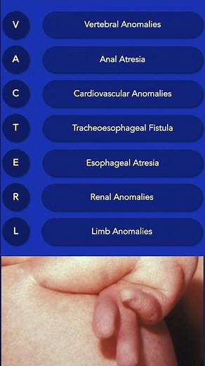 VACTERL Association: Clinical Features