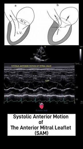 Systolic Anterior Motion of the Anterior Mitral Leaflet (SAM) #HOCM #MitralValve #LVOTObstruction