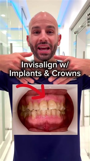 Don’t think you’re a candidate for Invisalign because you have implants and crowns in your mouth from previous dental work? Let our patient be the example you need! We only treat adults at our exclusively Invisalign practice. Adults tend to have previous dental work. And guess what…that’s okay! We are trained to work with the teeth you have to provide a result you can be happy with. If we don’t feel like we can execute for whatever reason, we won’t suggest treatment to begin with. That’s just th