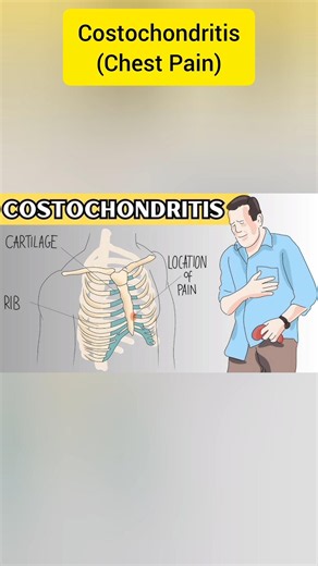 Costochondritis - Chest Pain Exercises at home #physiotherapy #costochondritis #healthylifestyle