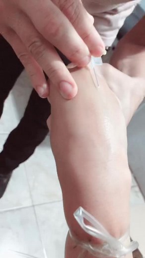 Blood Extraction Procedure: A Close-Up View