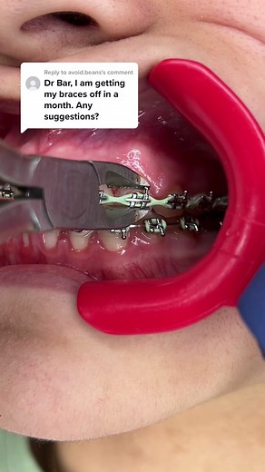 Replying to @avoid.beans Tips you’ll WANT to know if you’re Getting your Braces Off 🔥 #bracesoff #springtx #katytx