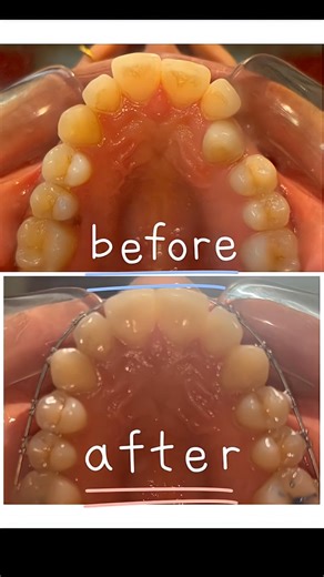Single tooth Crossbite #metal braces #smile makeover #Dr Babita Verma MDS