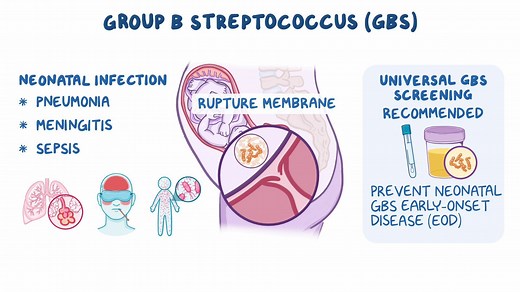 Video: Group B streptococcus (GBS) colonization in pregnancy: Clinical sciences - Video Explanation! | Osmosis | Osmosis