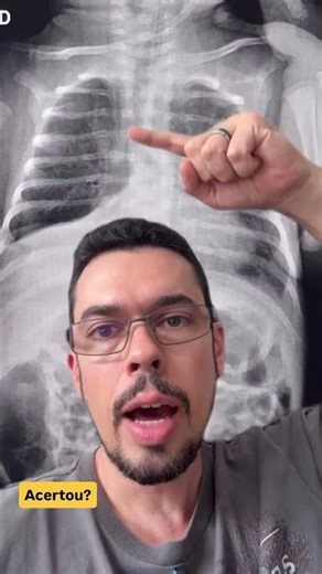 Nem toda opacidade na base é derrame