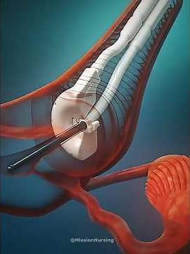 What Happens During Uterine Polyp Removal? #gynecology #shorts
