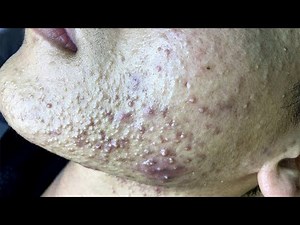 Satisfying relaxing deep skin clean acne and blackheads removal | 12