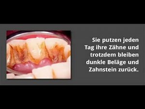 Zahnstein selbst entfernen mit Zahnsteinentferner Gerät