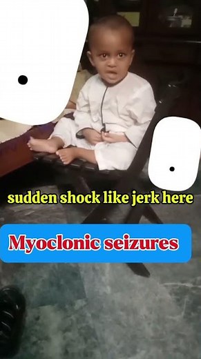 Myoclonic seizures | video presentation | seizures and epilepsy