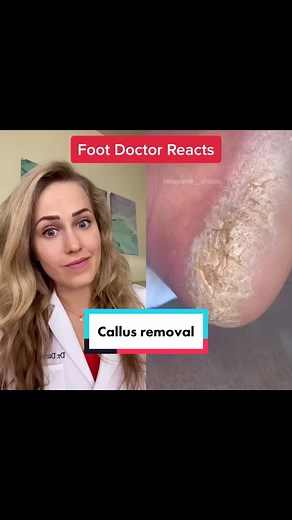 Thick Callus Removal with Pumice Stone by Podiatrist
