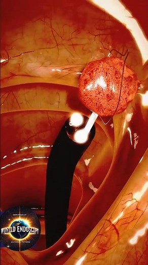 Colon polyp Removal - 3d Animation #hospital #doctor #duet #endoscopy #colonoscopy #polypremovel