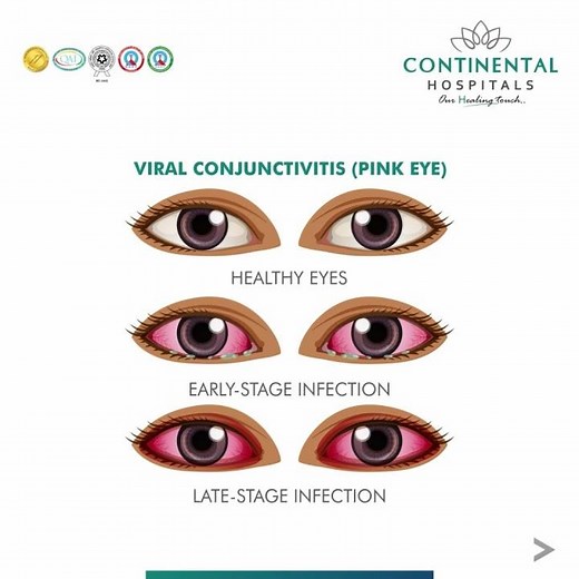 Conjunctivitis: What Is Pink Eye? | Continental Hospitals #pinkeye #conjunctivitis