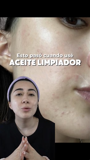 Cuando comencé a analizar los ingredientes y productos que estaban empeorando mi acné, me di cuenta de que muchos tipos de aceites limpiadores estaban obstruyendo mis poros. Desde que reemplacé el aceite por el agua micelar para hacerme la doble limpieza y desmaquillarme, finalmente vi mejores resultados en mi tratamiento contra el acné🫶🏻 Producto mencionado: 🩵 numbuzin Zero Blemish Oil-Free Micellar Jelly #numbuzin #acne #centella #micellarjelly #koreanskincare @numbuzin