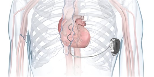 Jim’s Lifeline: Breakthrough Implant for Heart Failure