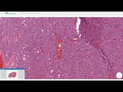 Oncocytic (Hürthle Cell) Adenoma - Thyroid Gland, Histopathology