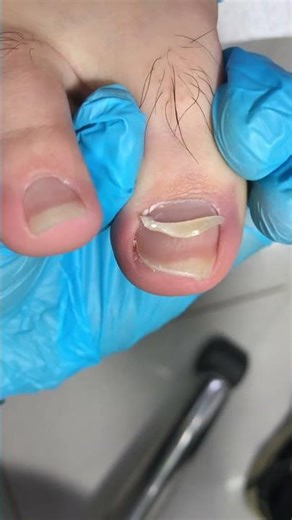 The Toenails Are Too Long; I Haven't Trimmed Them In Months! #nails