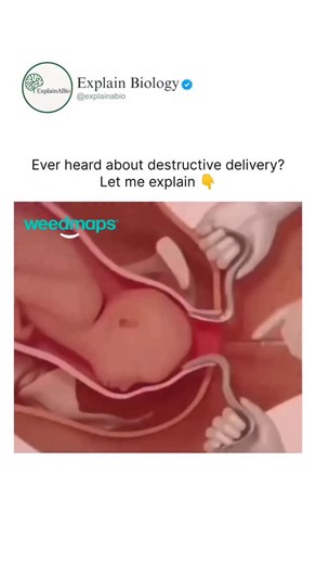 BIOLOGY | MEDICAL | LIFE on Instagram: "Destructive delivery is a rare obstetric procedure used only in extreme cases when a fetus has already demised or is severely deformed, making normal delivery impossible. It involves reducing the size of the fetus to allow safe vaginal delivery and protect the mother’s life. 🩺 Though rarely performed today due to modern C-sections and advanced care, it may still be used in certain emergency situations. Follow us @explainabio for more 🔥 . . . . . . . . #m