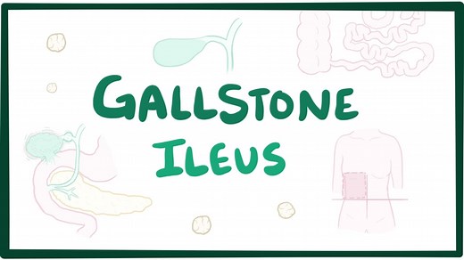 Gallstone ileus: Video, Causes, & Meaning | Osmosis