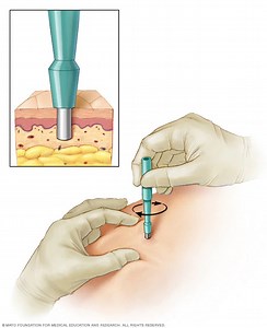 Skin Biopsy | Lab Tests Guide