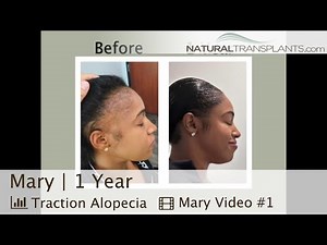 Turning Back the Clock for Traction Alopecia Patient Hairline! | Dr. Siegel (Mary)
