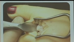 Tips, Quips & Pearls of the Weil Osteotomy