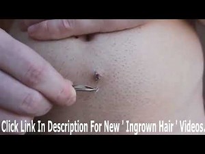 Longest ingrown hair & removal below belly button 2018
