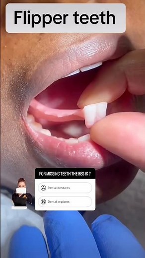PARTIAL FLIPPER DENTURE 🦷😬