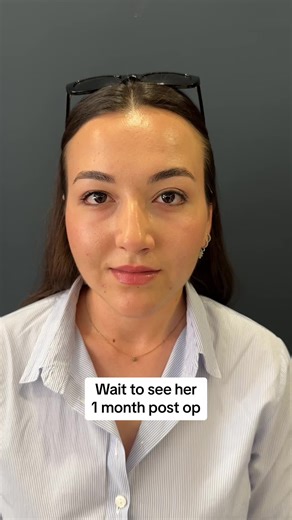 Crooked nose case! Look how strsight and symmetrical her nose is now #rhinoplasty #nosejobturkey