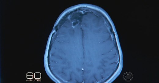 The FDA has declared a breakthrough for treatment against a vicious form of brain cancer