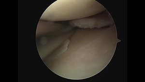 All-Inside Repair of Radial Medial Meniscus Tear