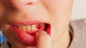 The boy is crying, experiencing a little pain after his front baby tooth was pulled out.