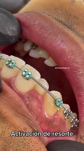 La Magia de los Resortes en Ortodoncia: Tipos y Funciones