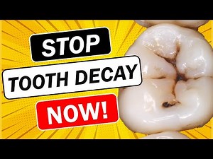 EASIEST Way To STOP Dental Caries (Tooth Decay)