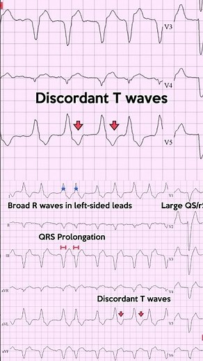 Left bundle branch block (LBBB) ECG: Example 5