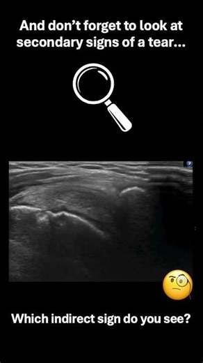 Shoulder ultrasound scanning tip - probe pressure