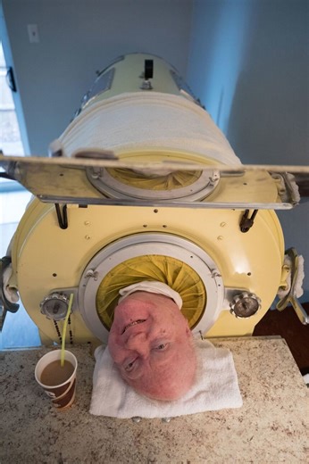 ‘Polio Paul,’ who spent most of the past 70 years in an iron lung, dies at 78