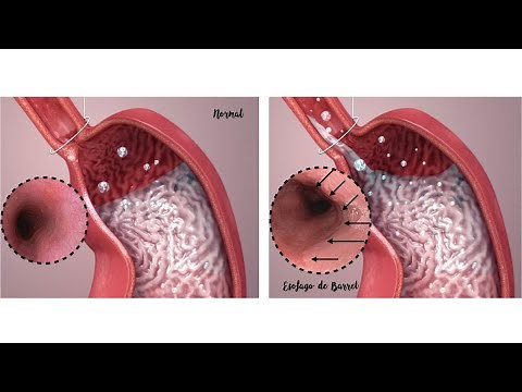 BARRET'S ESOPHAGUS CAUSES, SYMPTOMS AND TREATMENT COMPLICATIONS OF GASTROESOPHAGEAL REFLUX