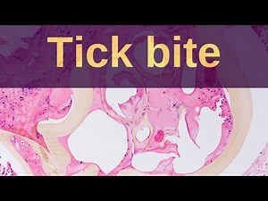 Tick Bites - Pathology mini tutorial