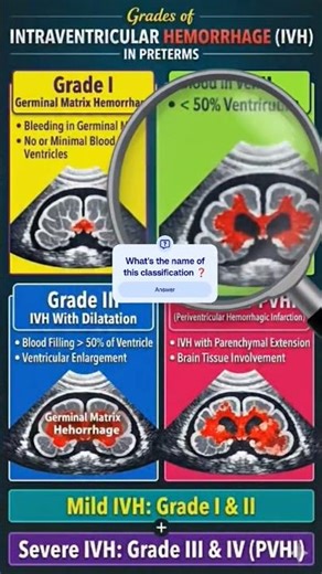 IVH classification #pediatrics #mbbs #neet #fmge #mcq #medicosstuff #neet #usmle