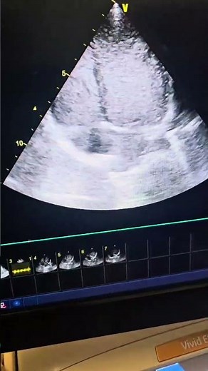 Agitated Saline Contrast Echocardiography | bubble saline contrast echocardiogram | PFO & AVM