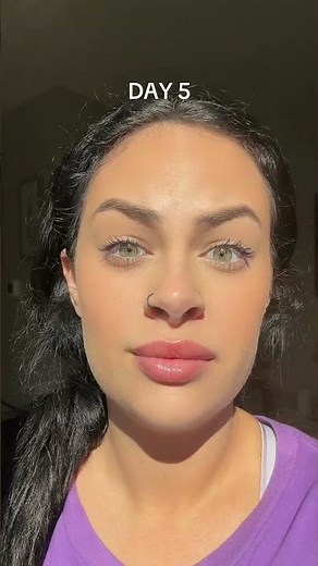 Forehead Botox! #botox #botoxresults